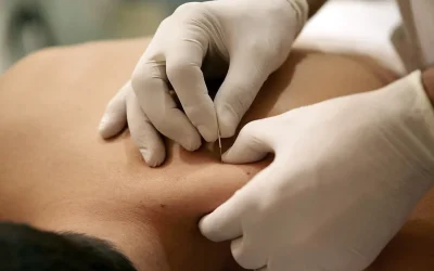 Dry Needling VS Acupuncture